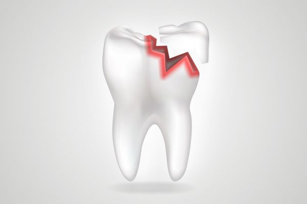 Odbudowa złamanych zębów
